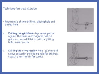 Technique for screw insertion
• Require use of two drill bits- gliding hole and
thread hole
1. Drilling the glide hole- tap sleeve placed
against the bone in orthogonal fashion
guides 2.7 mm drill bit to drill the gliding
hole in near cortex
2. Drilling the compression hole – (2 mm) drill
sleeve seated in the gliding hole for drilling a
coaxial 2 mm hole in far cortex
 
