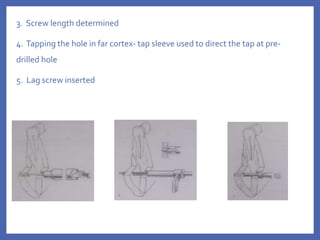 3. Screw length determined
4. Tapping the hole in far cortex- tap sleeve used to direct the tap at pre-
drilled hole
5. Lag screw inserted
 