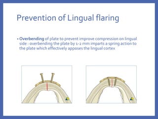 Prevention of Lingual flaring
• Overbending of plate to prevent improve compression on lingual
side : overbending the plate by 1-2 mm imparts a spring action to
the plate which effectively apposes the lingual cortex
 