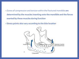 • Zones of compression and tension within the fractured mandible are
determined by the muscles inserting onto the mandible and the forces
exerted by these muscles during function
• Stress points also vary according to the bite location
 