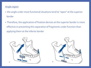 Angle region
• the angle under most functional situations tend to “open” at the superior
border
• Therefore, the application of fixation devices at the superior border is more
effective in preventing this separation of fragments under function than
applying them at the inferior border
 