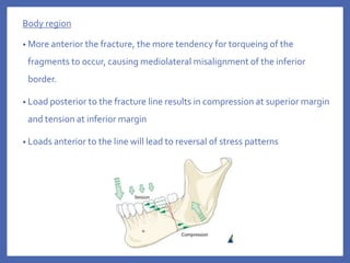 Body region
• More anterior the fracture, the more tendency for torqueing of the
fragments to occur, causing mediolateral misalignment of the inferior
border.
• Load posterior to the fracture line results in compression at superior margin
and tension at inferior margin
• Loads anterior to the line will lead to reversal of stress patterns
 