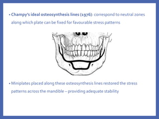 • Champy’s ideal osteosynthesis lines (1976): correspond to neutral zones
along which plate can be fixed for favourable stress patterns
• Miniplates placed along these osteosynthesis lines restored the stress
patterns across the mandible – providing adequate stability
 