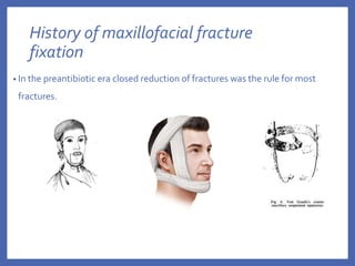History of maxillofacial fracture
fixation
• In the preantibiotic era closed reduction of fractures was the rule for most
fractures.
 