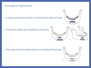 • Examples of rigid fixation
 Large compression plate in combination with arch bar
 Two bone plates for mandibular fractures
 Two lag screws inserted across a symphysial fractures
 
