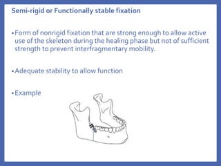 Semi-rigid or Functionally stable fixation
•Form of nonrigid fixation that are strong enough to allow active
use of the skeleton during the healing phase but not of sufficient
strength to prevent interfragmentary mobility.
•Adequate stability to allow function
•Example
 