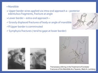 • Mandible
 Upper border wires applied via intra-oral approach a – posterior
edentulous fragments, fracture at angle
Lower border – extra-oral approach –
 Grossly displaced fractures of body or angle of mandible
If Upper border is comminuted
 Symphysis fractures ( tend to gape at lower border)
TransosseousWiring in theTreatment of Condylar
Fractures of the MandibleArviTasanen, MattiA. Lamberg
 