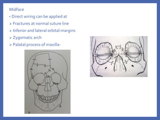 Midface
• Direct wiring can be applied at
 Fractures at normal suture line
 Inferior and lateral orbital margins
 Zygomatic arch
 Palatal process of maxilla-
 