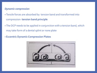 Dynamic compression
• Tensile forces are absorbed by tension band and transformed into
compression- tension band principle
• The DCP needs to be applied in conjunction with a tension band, which
may take form of a dental splint or none plate
• Eccentric Dynamic Compression Plates
 