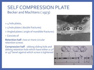 SELF COMPRESSION PLATE
Becker and Machtens ( 1973)
 4 hole plates,
 5 hole plates ( double fractures)
 Angled plates ( angle of mandible fractures)
• Consists of
Retention half : two or more circular
retention screws
Compression half : oblong sliding hole and
oblong retention hole which have either a 27°
or 45° bevel against which screw is tightened
 