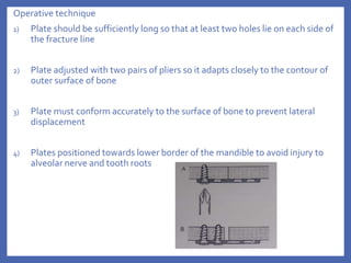 Operative technique
1) Plate should be sufficiently long so that at least two holes lie on each side of
the fracture line
2) Plate adjusted with two pairs of pliers so it adapts closely to the contour of
outer surface of bone
3) Plate must conform accurately to the surface of bone to prevent lateral
displacement
4) Plates positioned towards lower border of the mandible to avoid injury to
alveolar nerve and tooth roots
 