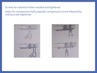 Screws for retention holes inserted and tightened
Holes for compression half prepared- compression screw followed by
sliding screw tightened
 