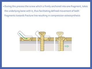 • During this process the screw which is firmly anchored into one fragment, takes
the underlying bone with it, thus facilitating defined movement of both
fragments towards fracture line resulting in compression osteosynthesis
 