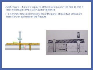 • Static screw – if a screw is placed at the lowest point in the hole so that it
does not create compression as it is tightened
• To eliminate rotational movements of the plate, at least two screws are
necessary on each side of the fracture
 