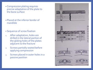• Compression plating requires
precise adaptation of the plate to
the bone surface
• Placed at the inferior border of
mandible
• Sequence of screw fixation
1. After adaptation, holes are
drilled in the lateral portion of
the gliding holes of the plates
adjacent to the fracture
2. Screws partially seated before
applying compression
3. Screws placed in outer holes in a
passive position
 