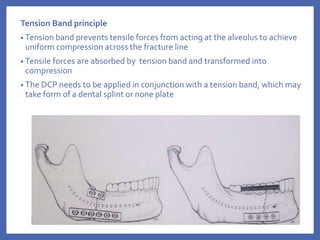 Tension Band principle
• Tension band prevents tensile forces from acting at the alveolus to achieve
uniform compression across the fracture line
• Tensile forces are absorbed by tension band and transformed into
compression
• The DCP needs to be applied in conjunction with a tension band, which may
take form of a dental splint or none plate
 