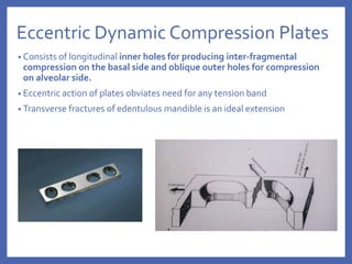 Eccentric Dynamic Compression Plates
• Consists of longitudinal inner holes for producing inter-fragmental
compression on the basal side and oblique outer holes for compression
on alveolar side.
• Eccentric action of plates obviates need for any tension band
• Transverse fractures of edentulous mandible is an ideal extension
 