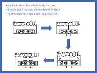 • Ideal indication : Mandibular body fractures
• Six hole EDCP more stable than four hole EDCP
• Contraindicated in mandibular angle fractures
 