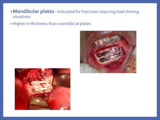 •Mandibular plates : Indicated for fractures requiring load sharing
situations
• Higher in thickness than craniofacial plates
 
