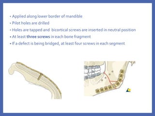 • Applied along lower border of mandible
• Pilot holes are drilled
• Holes are tapped and bicortical screws are inserted in neutral position
• At least three screws in each bone fragment
• If a defect is being bridged, at least four screws in each segment
 