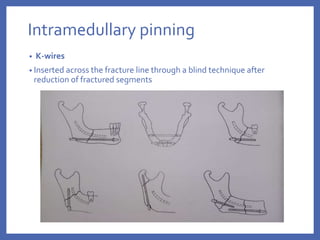Intramedullary pinning
• K-wires
• Inserted across the fracture line through a blind technique after
reduction of fractured segments
 