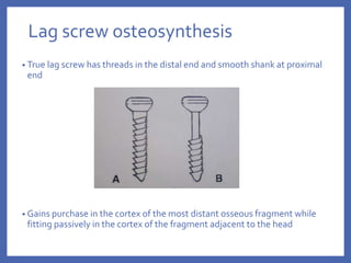 Lag screw osteosynthesis
• True lag screw has threads in the distal end and smooth shank at proximal
end
• Gains purchase in the cortex of the most distant osseous fragment while
fitting passively in the cortex of the fragment adjacent to the head
 