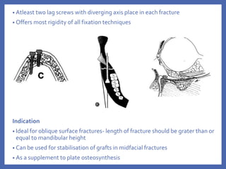 • Atleast two lag screws with diverging axis place in each fracture
• Offers most rigidity of all fixation techniques
Indication
• Ideal for oblique surface fractures- length of fracture should be grater than or
equal to mandibular height
• Can be used for stabilisation of grafts in midfacial fractures
• As a supplement to plate osteosynthesis
 
