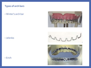 Types of arch bars
• Winter’s arch bar
• Jelenko
• Erich
 