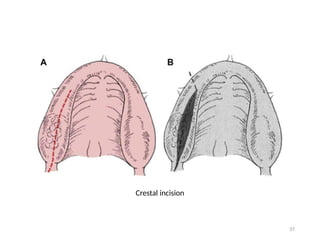 Preprosthetic surgery in Oral and maxillofacial surgery | PPTX