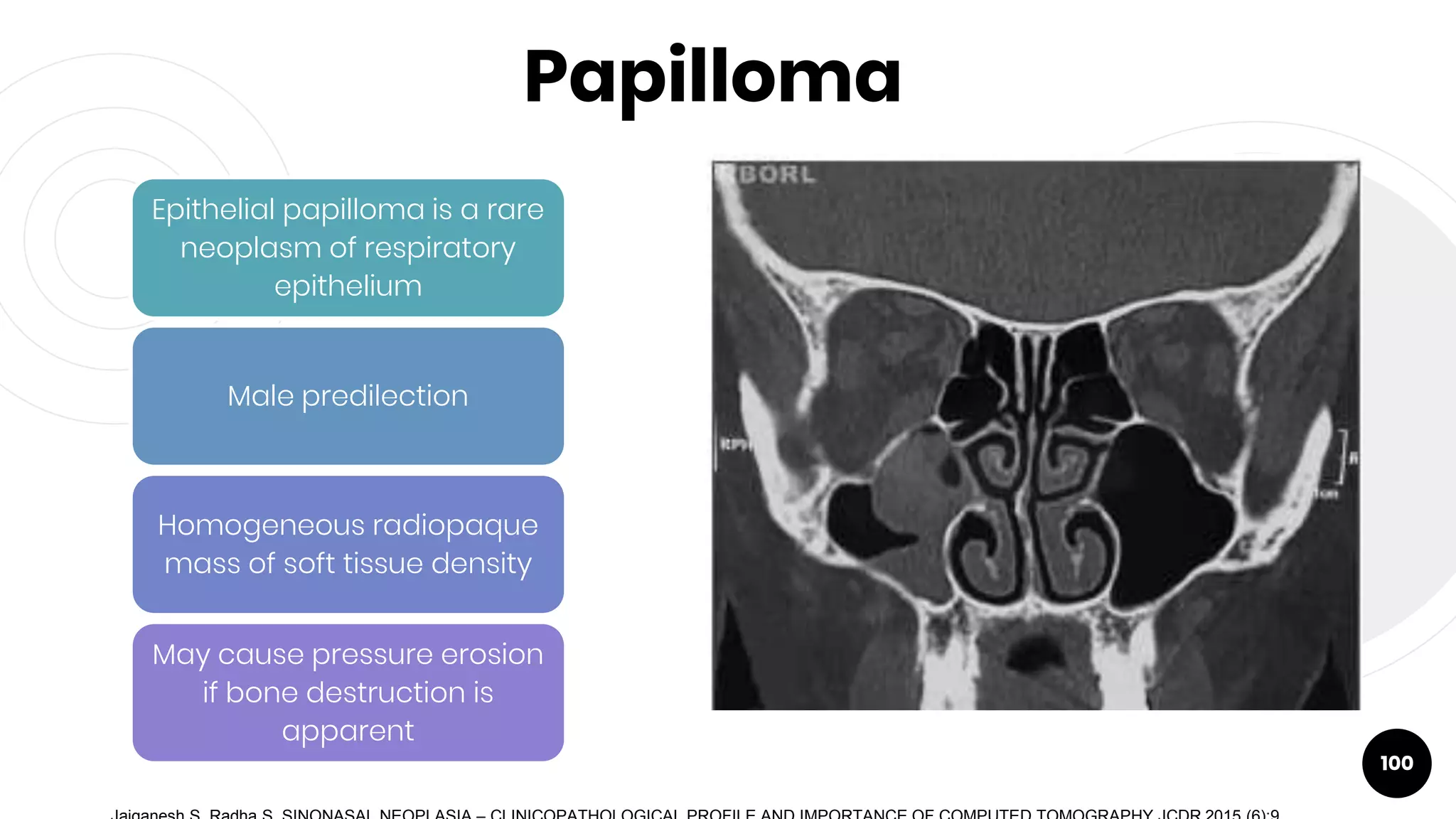 Papilloma
100
Epithelial papilloma is a rare
neoplasm of respiratory
epithelium
Male predilection
Homogeneous radiopaque
mass of soft tissue density
May cause pressure erosion
if bone destruction is
apparent
 