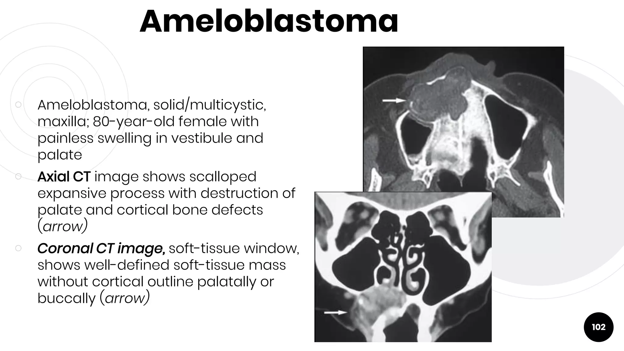 Ameloblastoma
￮ Ameloblastoma, solid/multicystic,
maxilla; 80-year-old female with
painless swelling in vestibule and
palate
￮ Axial CT image shows scalloped
expansive process with destruction of
palate and cortical bone defects
(arrow)
￮ Coronal CT image, soft-tissue window,
shows well-defined soft-tissue mass
without cortical outline palatally or
buccally (arrow)
102
 