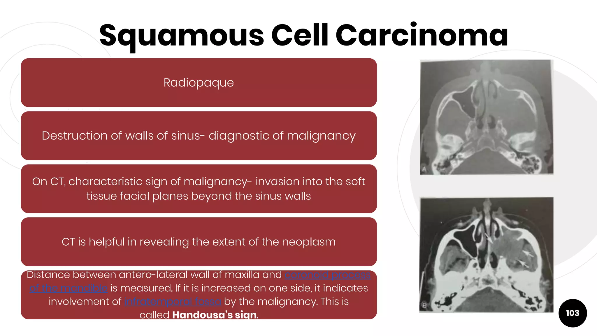Squamous Cell Carcinoma
103
Radiopaque
Destruction of walls of sinus- diagnostic of malignancy
On CT, characteristic sign of malignancy- invasion into the soft
tissue facial planes beyond the sinus walls
CT is helpful in revealing the extent of the neoplasm
Distance between antero-lateral wall of maxilla and coronoid process
of the mandible is measured. If it is increased on one side, it indicates
involvement of infratemporal fossa by the malignancy. This is
called Handousa's sign.
 