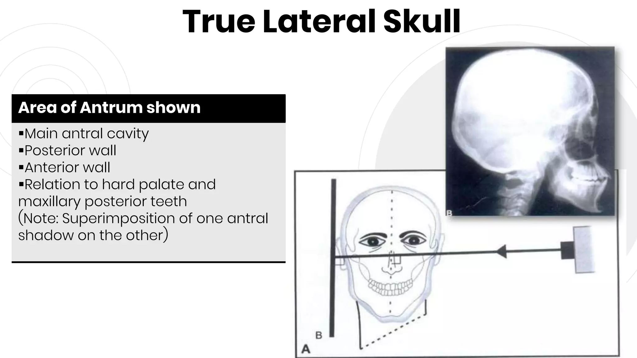 True Lateral Skull
42
Area of Antrum shown
Main antral cavity
Posterior wall
Anterior wall
Relation to hard palate and
maxillary posterior teeth
(Note: Superimposition of one antral
shadow on the other)
 
