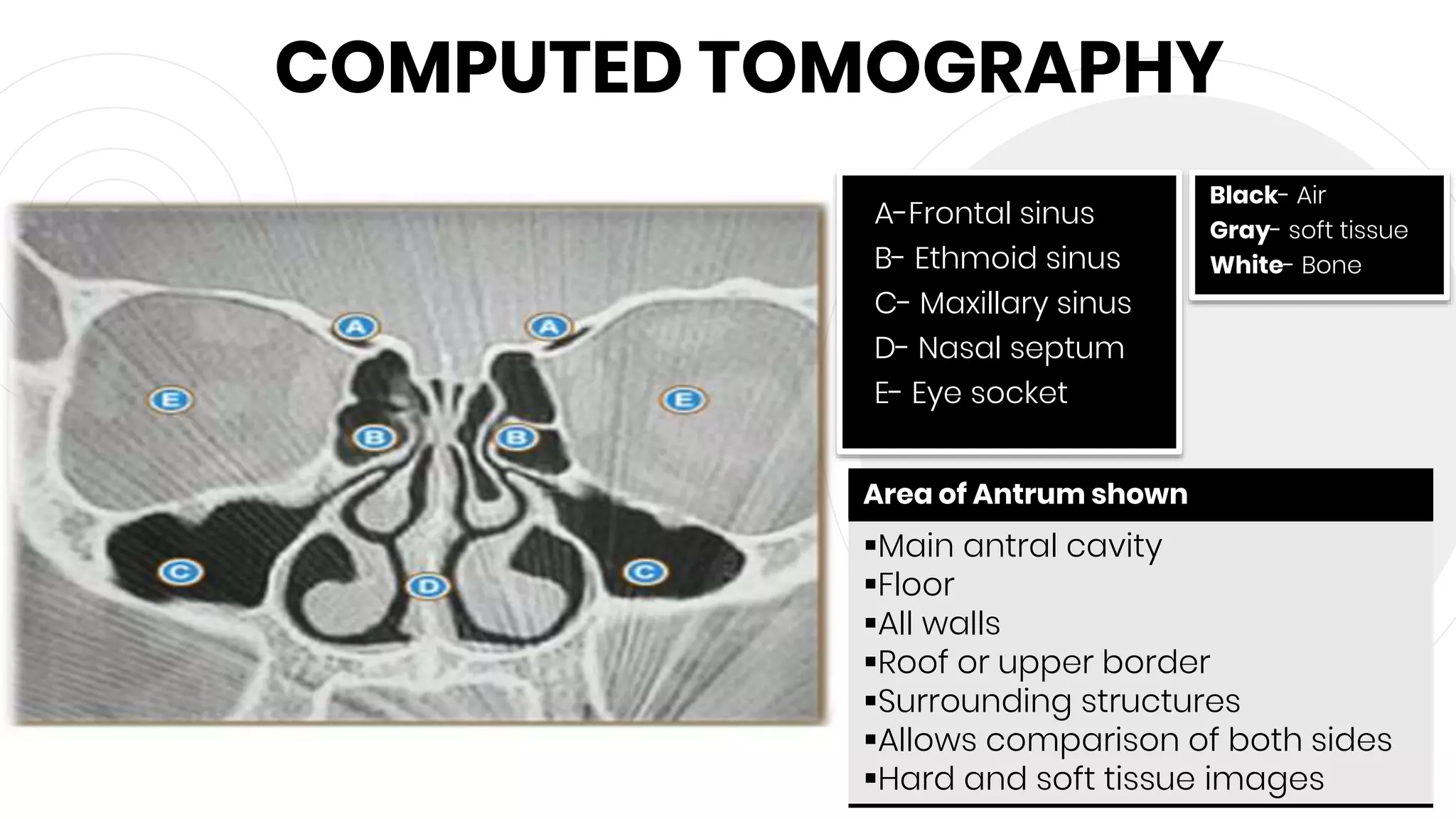 COMPUTED TOMOGRAPHY
46
A-Frontal sinus
B- Ethmoid sinus
C- Maxillary sinus
D- Nasal septum
E- Eye socket
Black- Air
Gray- soft tissue
White- Bone
Area of Antrum shown
Main antral cavity
Floor
All walls
Roof or upper border
Surrounding structures
Allows comparison of both sides
Hard and soft tissue images
 