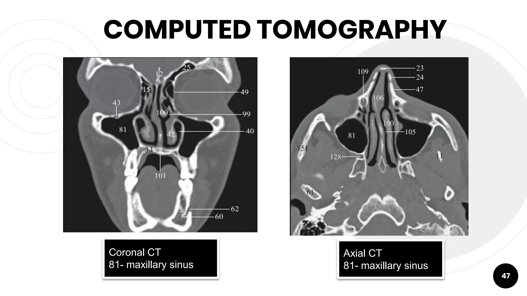 COMPUTED TOMOGRAPHY
47
Coronal CT
81- maxillary sinus
Axial CT
81- maxillary sinus
 