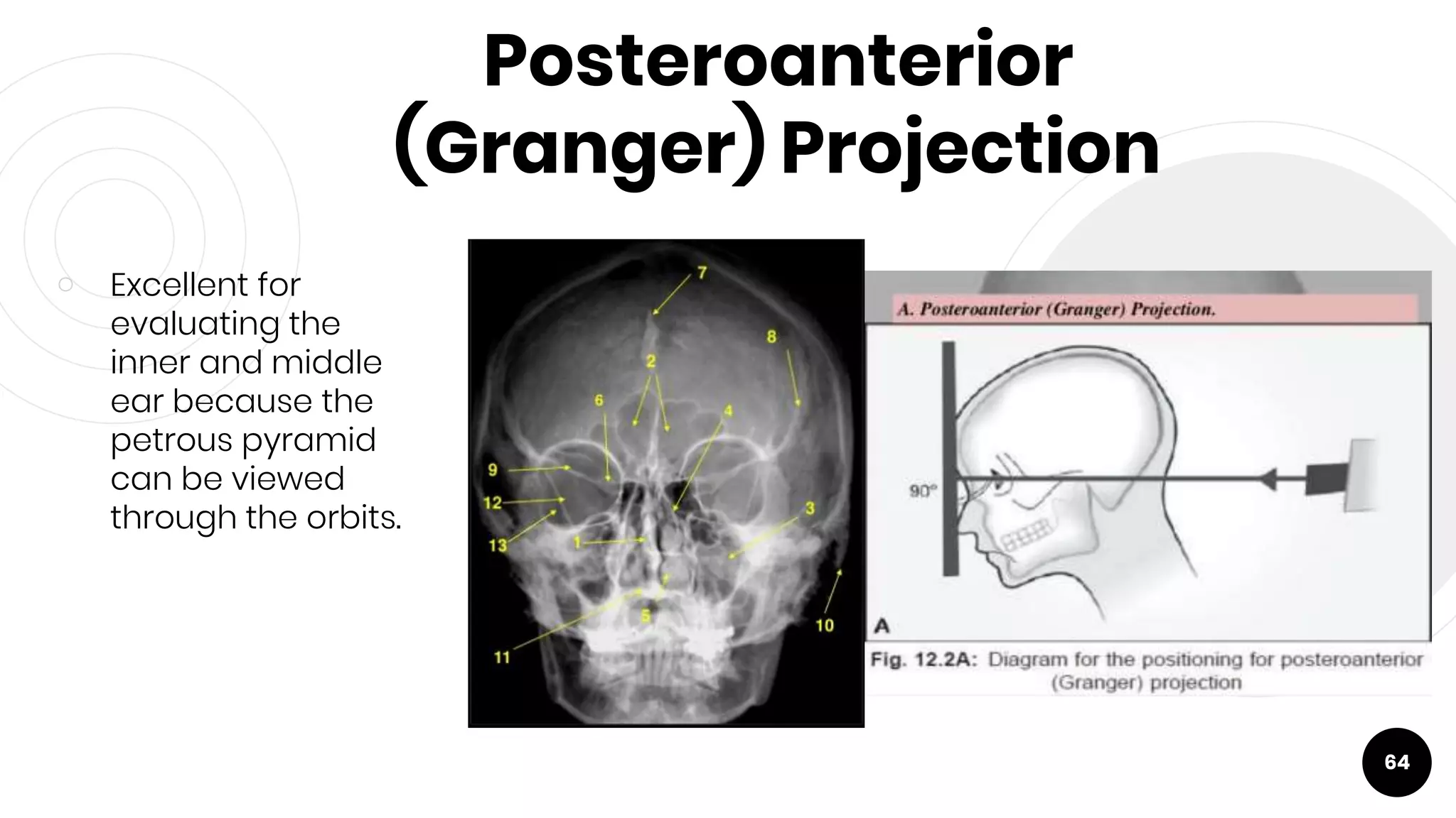 Posteroanterior
(Granger) Projection
￮ Excellent for
evaluating the
inner and middle
ear because the
petrous pyramid
can be viewed
through the orbits.
64
 