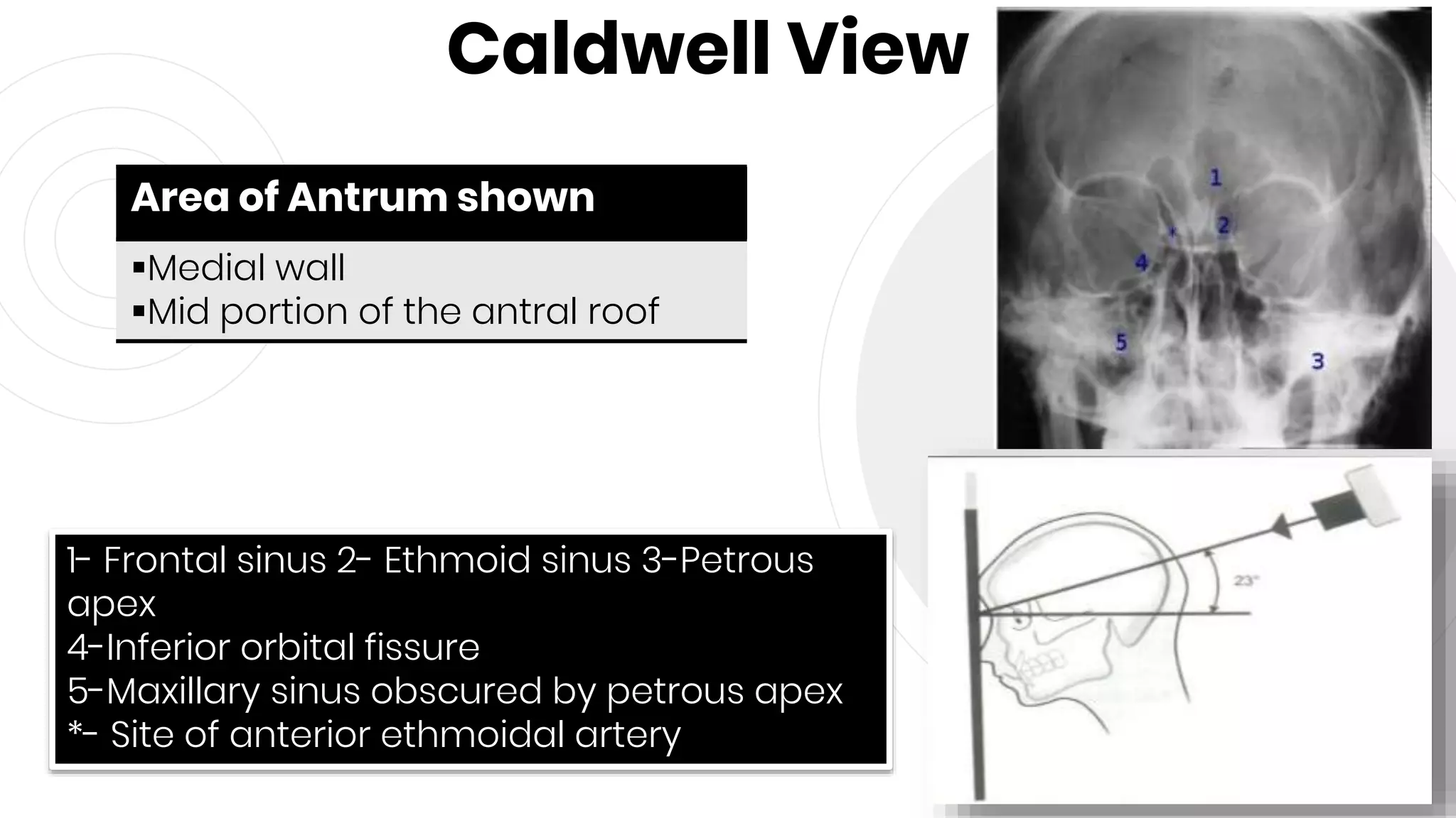 Caldwell View
65
Area of Antrum shown
Medial wall
Mid portion of the antral roof
1- Frontal sinus 2- Ethmoid sinus 3-Petrous
apex
4-Inferior orbital fissure
5-Maxillary sinus obscured by petrous apex
*- Site of anterior ethmoidal artery
 