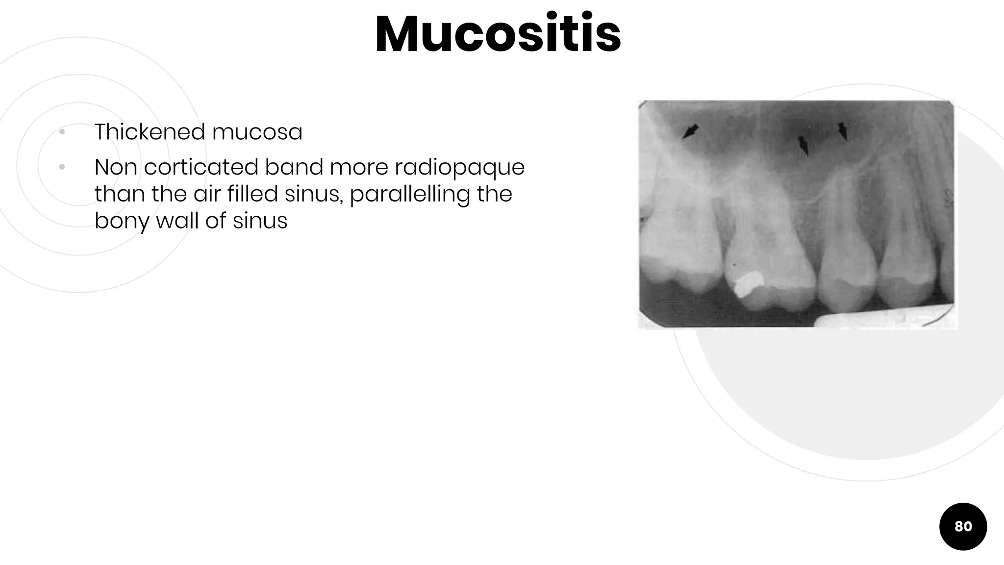 Mucositis
• Thickened mucosa
• Non corticated band more radiopaque
than the air filled sinus, parallelling the
bony wall of sinus
80
 