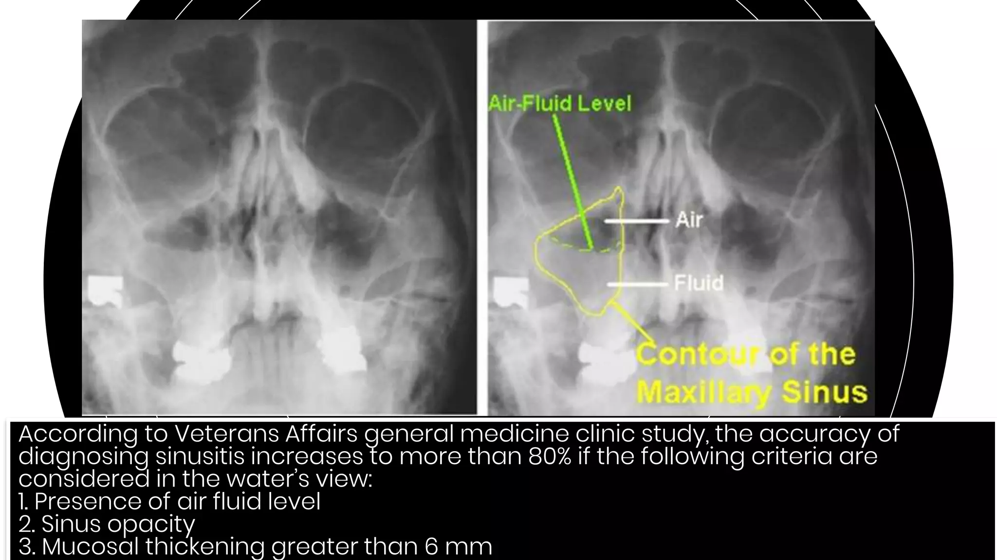 82
According to Veterans Affairs general medicine clinic study, the accuracy of
diagnosing sinusitis increases to more than 80% if the following criteria are
considered in the water’s view:
1. Presence of air fluid level
2. Sinus opacity
3. Mucosal thickening greater than 6 mm
 