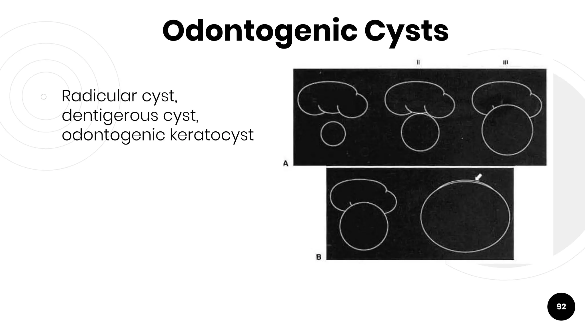 Odontogenic Cysts
￮ Radicular cyst,
dentigerous cyst,
odontogenic keratocyst
92
 