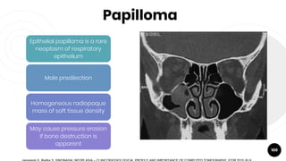 Papilloma
100
Epithelial papilloma is a rare
neoplasm of respiratory
epithelium
Male predilection
Homogeneous radiopaque
mass of soft tissue density
May cause pressure erosion
if bone destruction is
apparent
 