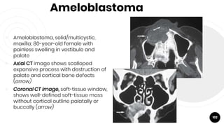 Ameloblastoma
￮ Ameloblastoma, solid/multicystic,
maxilla; 80-year-old female with
painless swelling in vestibule and
palate
￮ Axial CT image shows scalloped
expansive process with destruction of
palate and cortical bone defects
(arrow)
￮ Coronal CT image, soft-tissue window,
shows well-defined soft-tissue mass
without cortical outline palatally or
buccally (arrow)
102
 