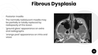 Fibrous Dysplasia
￮ Posterior maxilla
￮ The normally radiolucent maxilla may
be partially or totally replaced by
radiopacity of this lesion
￮ ‘ground glass’ appearance on extra
oral radiographs
￮ ‘orange peel’ appearance on intra oral
views
105
 