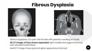 Fibrous Dysplasia
￮ Fibrous dysplasia; 23-year-old female with painless swelling of cheek.
￮ 3D CT image, of face shows expanded right maxilla and zygoma (arrow)
with elevated orbital floor.
￮ Axial CT image shows ground-glass appearance (arrow). 106
 
