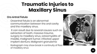 Traumatic Injuries to
Maxillary Sinus
Oro Antral Fistula
￮ Oroantral fistula is an abnormal
communication between the oral cavity
and the maxillary sinus.
￮ It can result due to several causes such as
extraction of teeth, massive trauma,
surgery to maxillary sinus, osteomyelitis of
maxilla, malignant tumor, infected upper
implant denture, Malignant granuloma
￮ Radiograph may show break in continuity of floor
of maxillary sinus
109
 