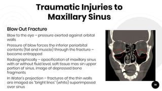 Traumatic Injuries to
Maxillary Sinus
Blow Out Fracture
Blow to the eye – pressure exerted against orbital
walls
Pressure of blow forces the inferior periorbital
contents (fat and muscle) through the fracture –
become entrapped
Radiographically – opacification of maxillary sinus
with or without fluid level, soft tissue mas sin upper
portion of sinus, image of depressed bone
fragments
In Water’s projection – fractures of the thin walls
are imaged as “bright lines” (white) superimposed
over sinus
111
 
