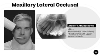 Maxillary Lateral Occlusal
36
Area of Antrum shown
Floor
Lower half of antral cavity
Relationship with upper
posterior teeth
 
