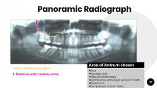 Panoramic Radiograph
37
1. Floor of Maxillary Sinus
1
2
2. Posterior wall maxillary sinus
Area of Antrum shown
Floor
Posterior wall
Base of antral cavity
Relationship with upper posterior teeth
Medial wall
Comparison of both sides
 