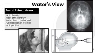 Water’s View
40
Area of Antrum shown
Antral cavity
Roof of the antrum
Lateral and medial wall
Comparison of internal
radiopacities
 