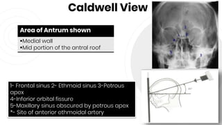 Caldwell View
43
Area of Antrum shown
Medial wall
Mid portion of the antral roof
1- Frontal sinus 2- Ethmoid sinus 3-Petrous
apex
4-Inferior orbital fissure
5-Maxillary sinus obscured by petrous apex
*- Site of anterior ethmoidal artery
 
